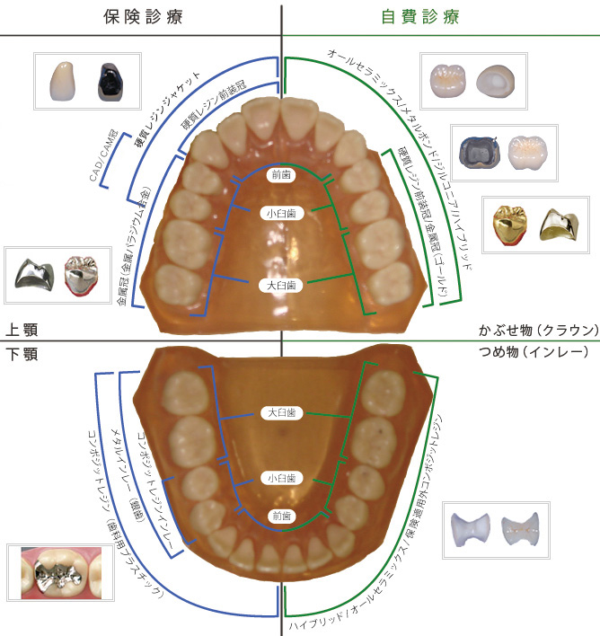 被せものの種類