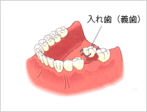 取り出し式の入れ歯(義歯)を用いる場合