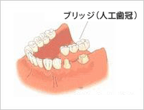 固定式の入れ歯(ブリッジ)を用いる場合