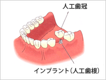 インプラントという人工歯根を入れた場合