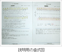 説明用の歯式図